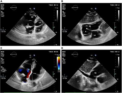 Right atrial cardiac lipoma with distinctive imaging characteristics. A rare case report and literature review